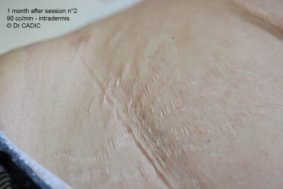 Photo Gallery - before and after pictures of carboxytherapy, FDA ...